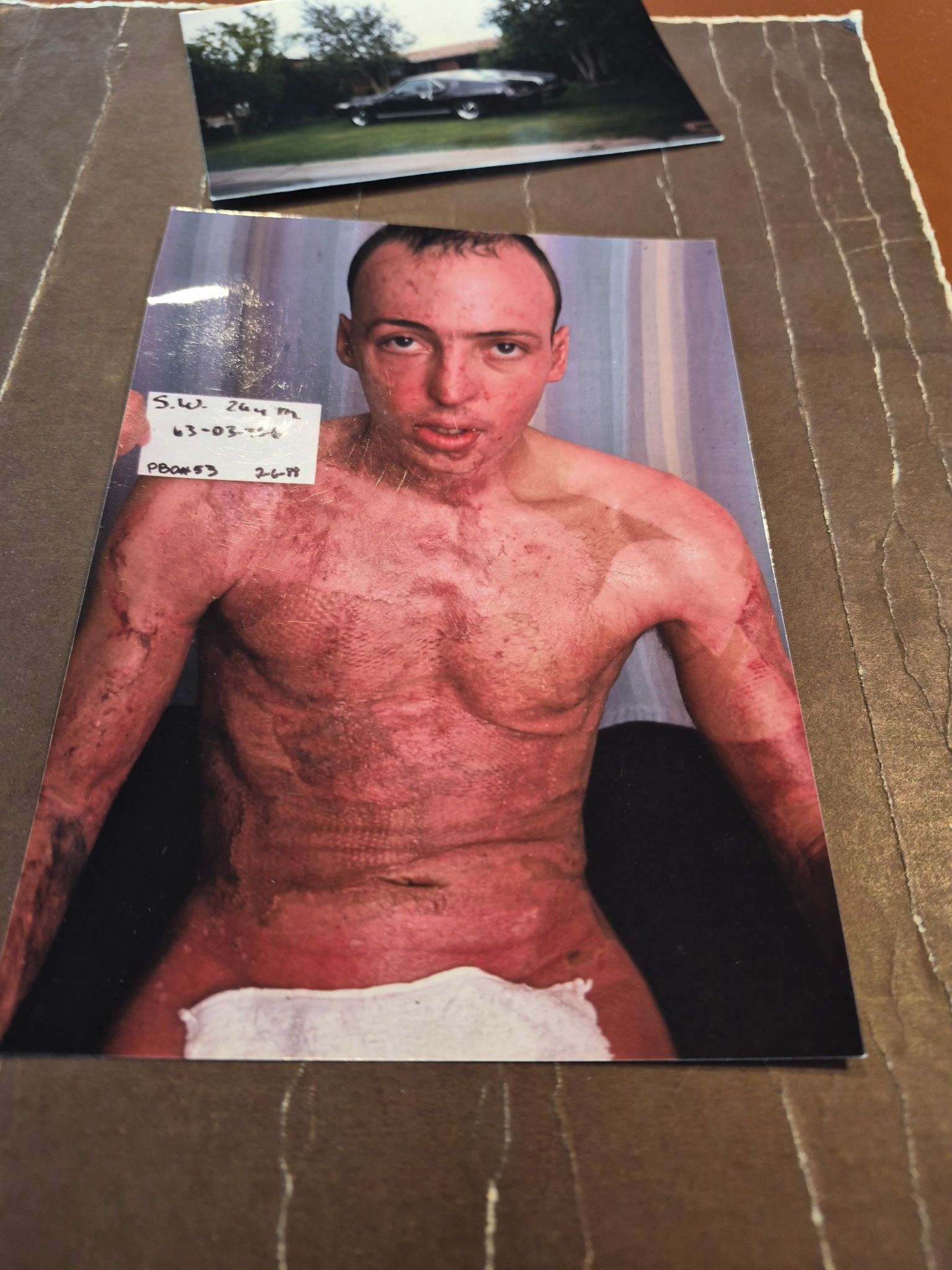 Scott Wolt — physical photograph from burn recovery period, medical label visible